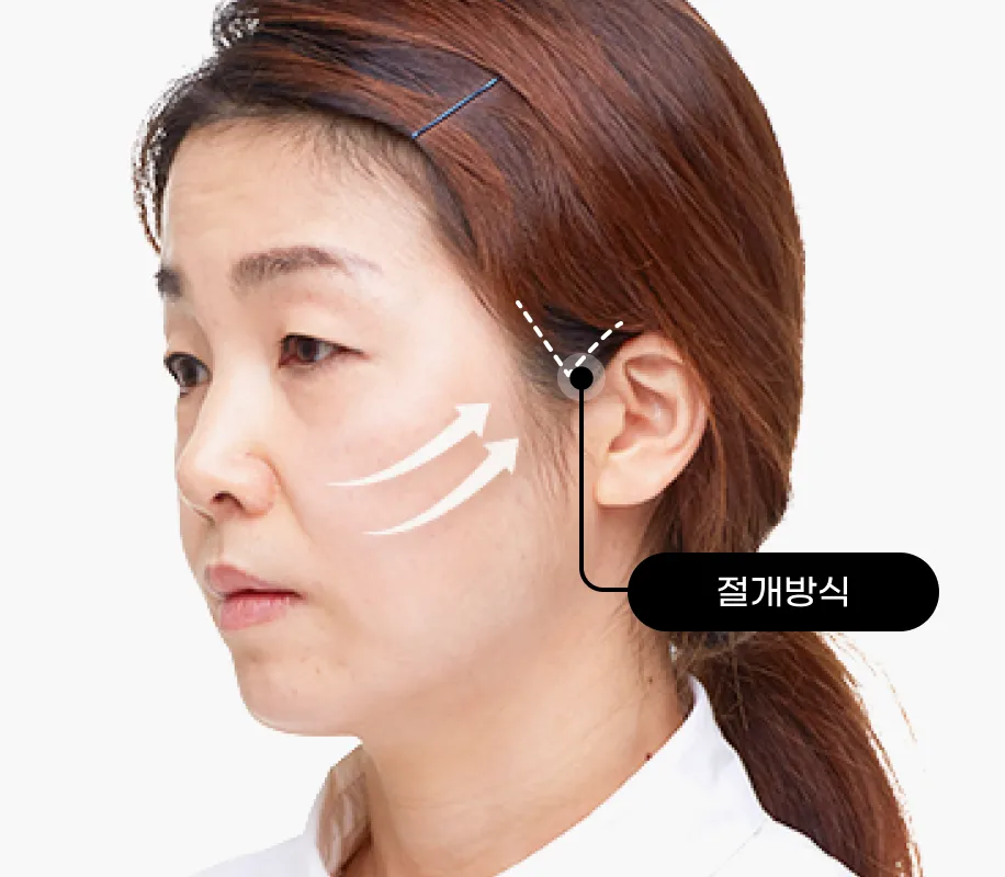 기린 초미니 리프팅 case1 절개방식