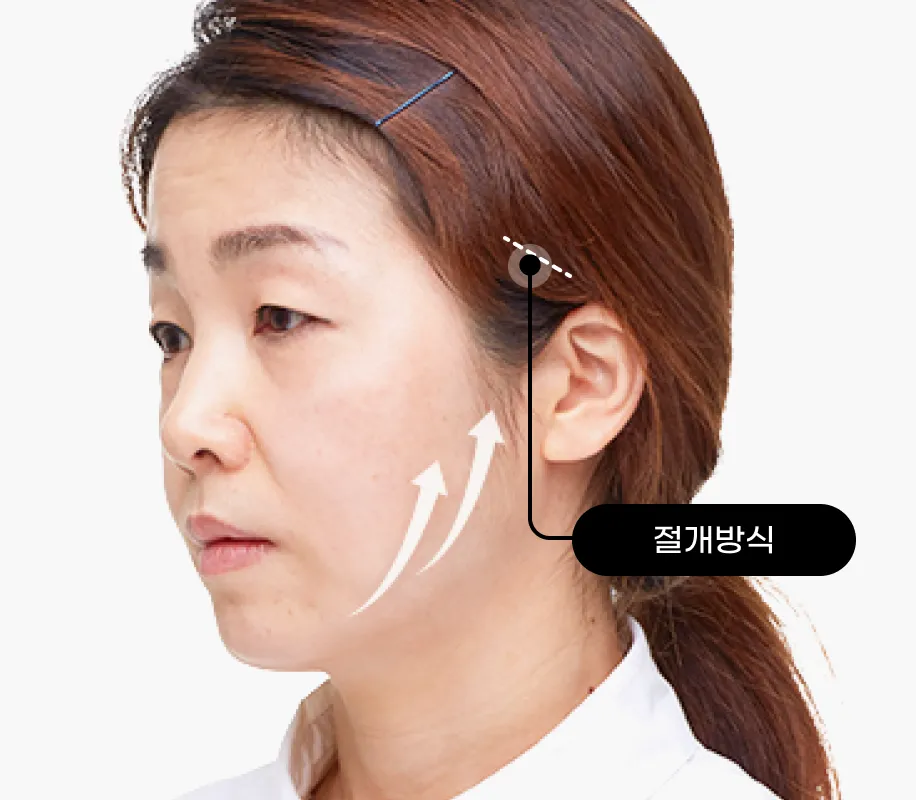 기린 초미니 리프팅 case2 절개방식