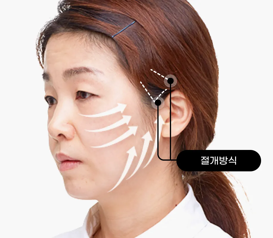 기린 초미니 리프팅 case3 절개방식
