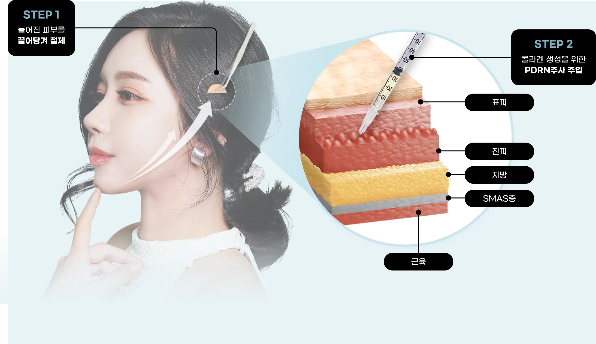 기린 초미니 리프팅 수술방법 Step1 : 늘어진 피부를 끌어당겨 절제, Step2 : 콜라겐 생성을 위한 PDRN주사 주입