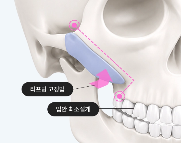 리프팅 고정법, 입안 최소절개