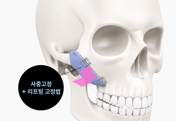 사중고정 + 리프팅 고정법